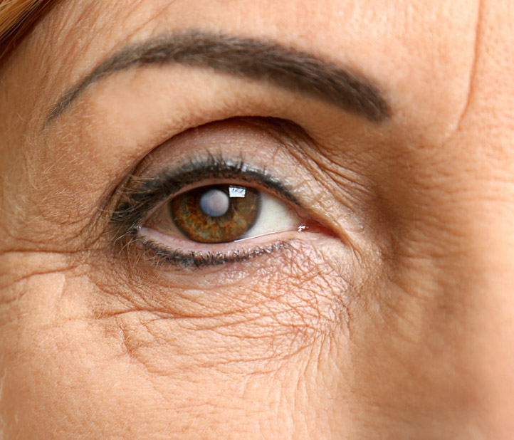 Cataract Eye Condition Treatment at Rosin Eyecare in Chicago, IL