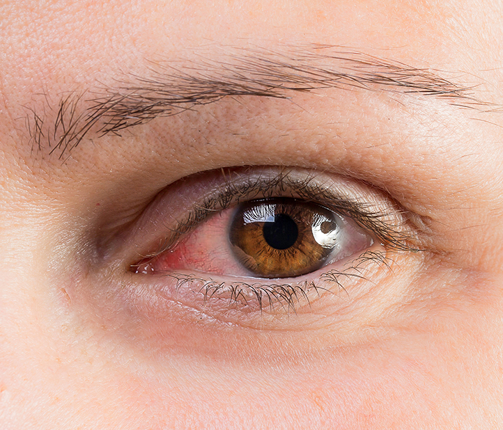 Dry Eye Treatment at Rosin Eyecare in Chicago